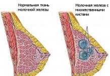 Фиброаденоматоз молочной железы